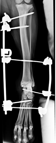 Post-operative radiograph showing lag screw repair being protected by a trans-articular fixator